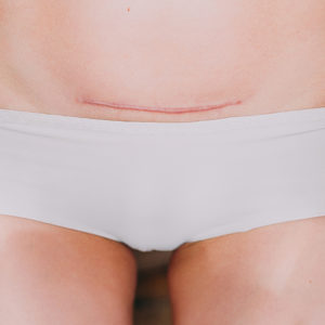 How to recover from a C-section